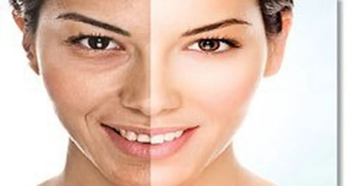 ابداع روشی جدید برای کاهش آثار زخم