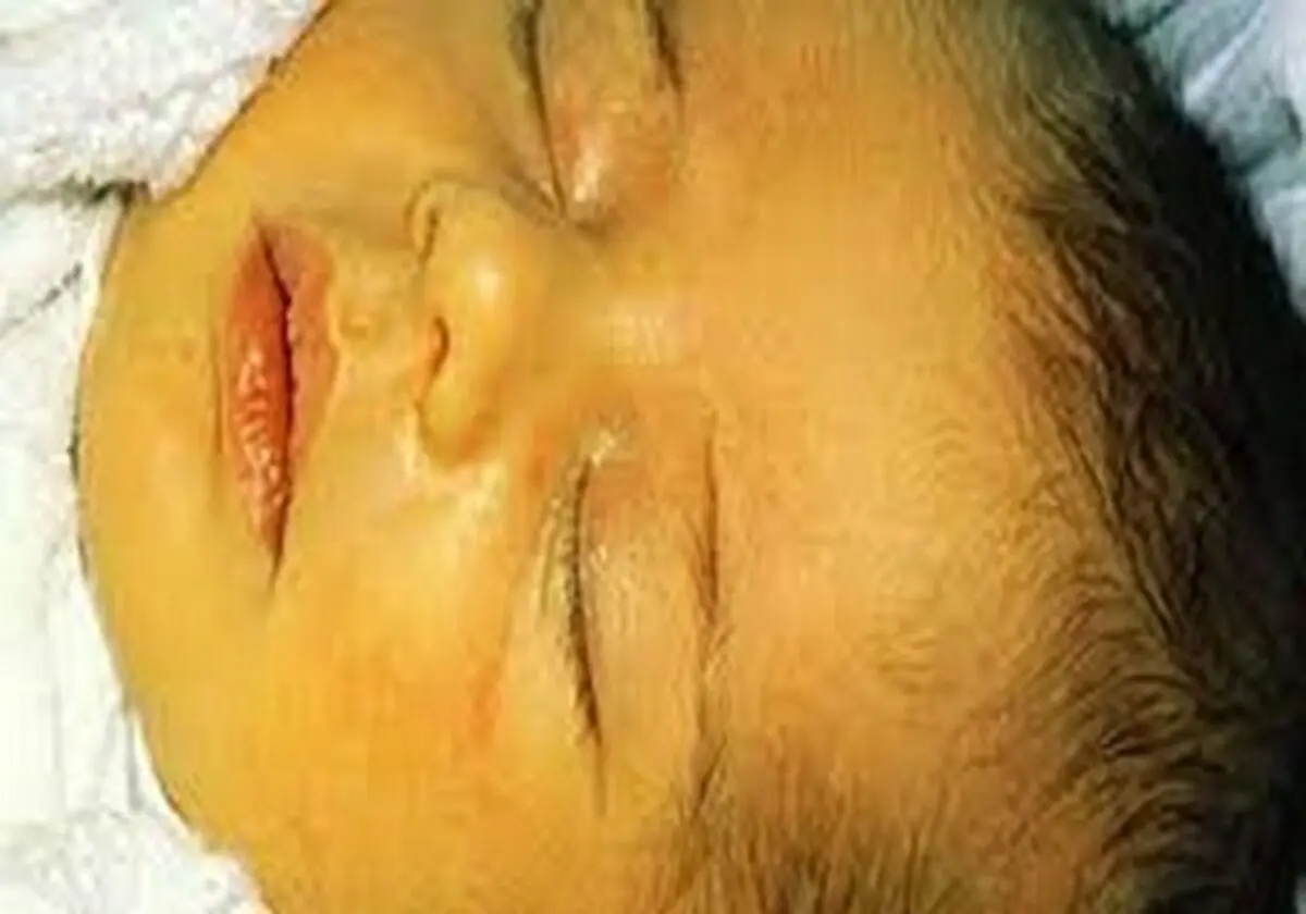 آیا مسکن ها می توانند باعث ایجاد زردی شوند؟
