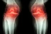 روش درمان آرتروز با شناسایی سیگنال درد
