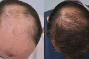 تولید دارویی جدید برای احیای مو‌های ریخته
