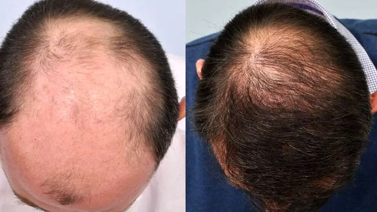 تولید دارویی جدید برای احیای موهای ریخته