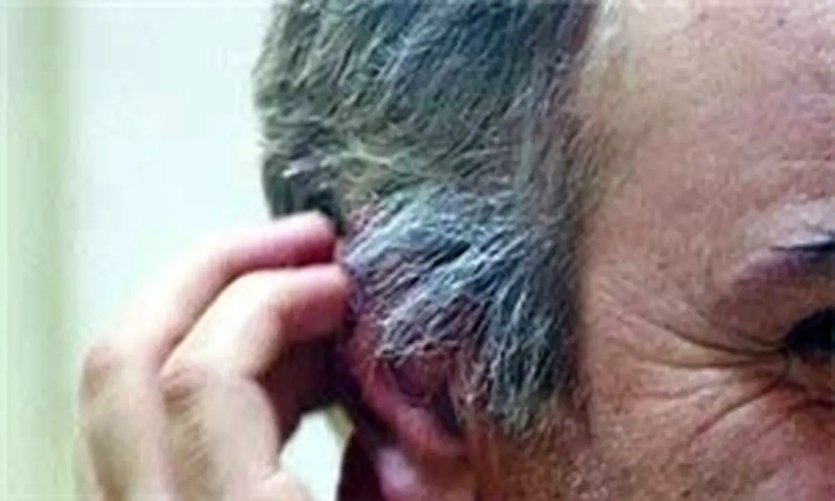 عوامل سفیدی مو را بشناسید
