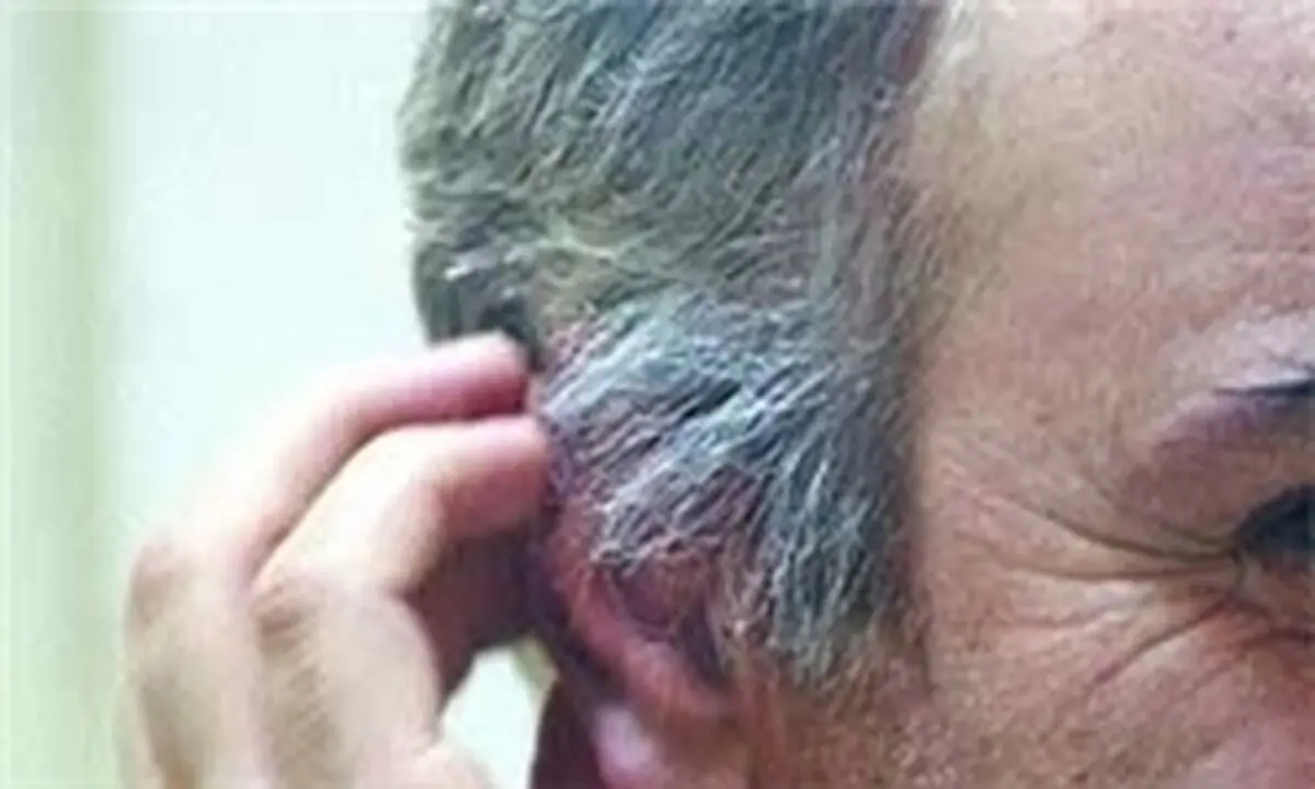عوامل سفیدی مو را بشناسید