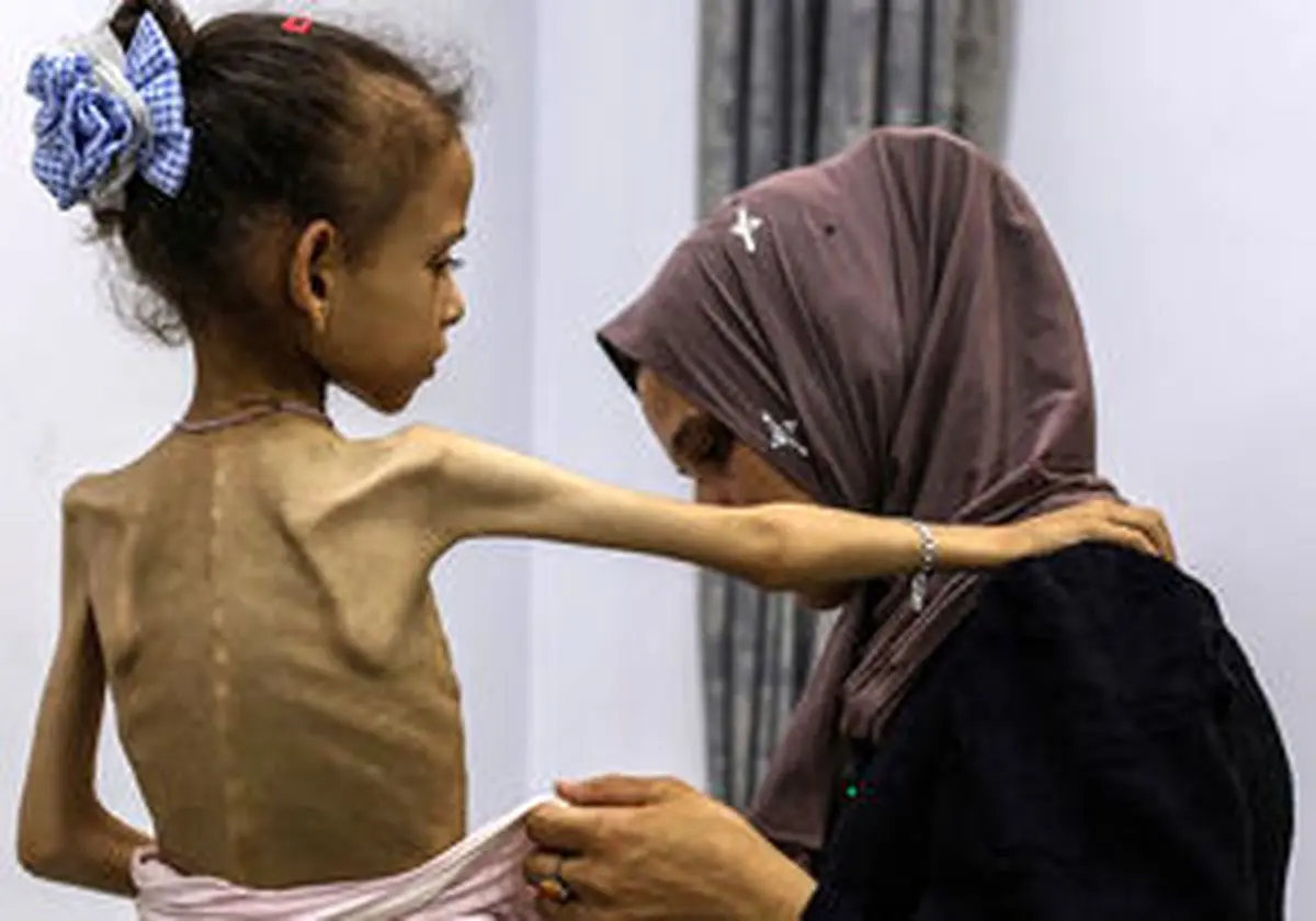 
سوء تغذیه در غزه از ۹۰ درصد فراتر رفته است
