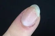 چرا ناخن ها می شکند؟