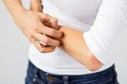 راهکار‌هایی برای پیشگیری از تشدید اگزما در زمستان +اینفوگرافیک