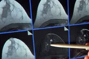 هشدار: ماموگرافی سرطان زاست!
