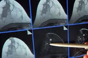 هشدار: ماموگرافی سرطان زاست!