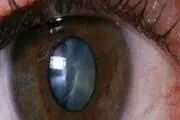 عوامل ابتلا به آب مروارید