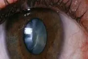 مواظب «مروارید بدن» باشید!
