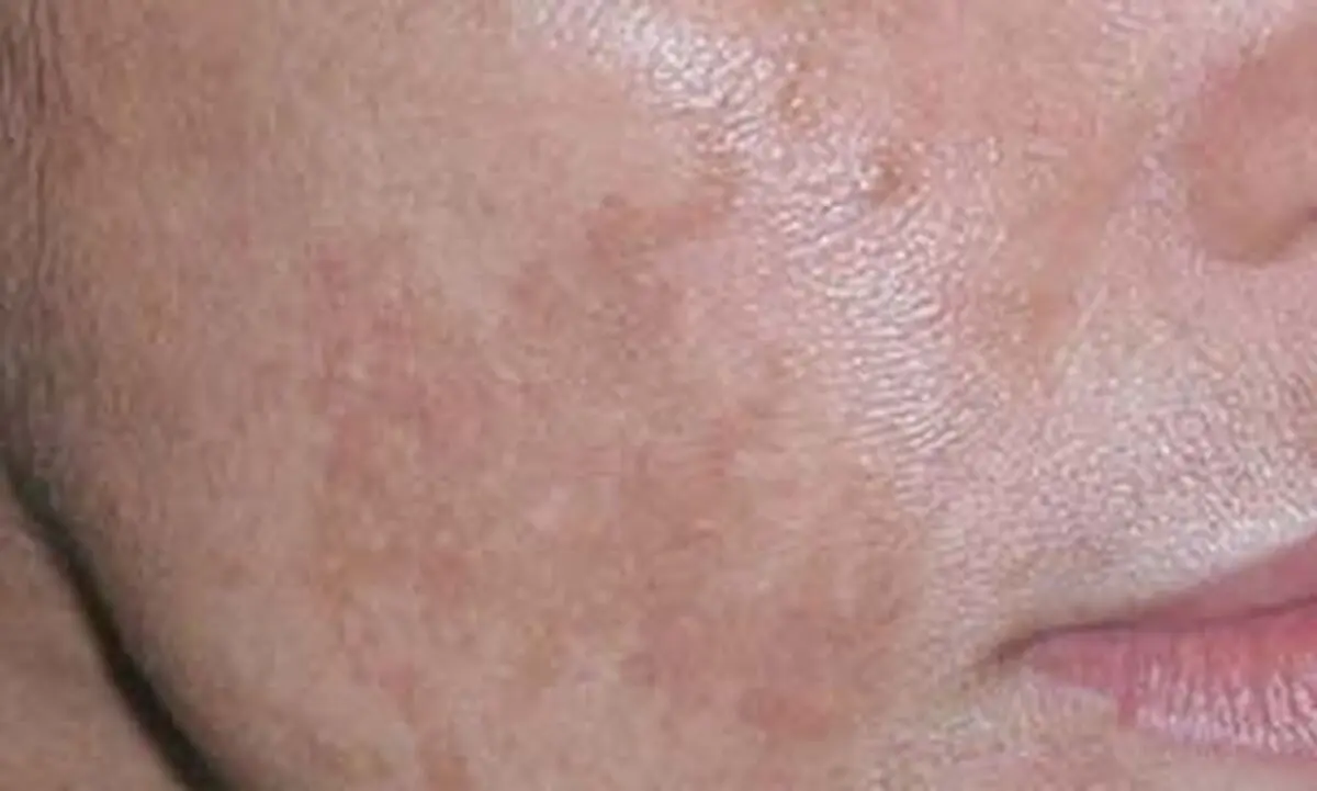 راه‌های خلاصی از کک و مک 