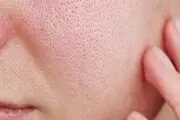 راهکارهای طبیعی برای از بین بردن قرمزی صورت
