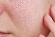راهکارهای طبیعی برای از بین بردن قرمزی صورت
