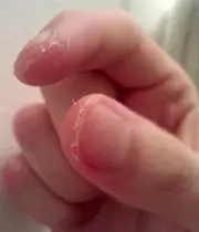 ۱۵ راهکار ساده و سریع برای درمان پوسته پوسته شدن نوک انگشتان
