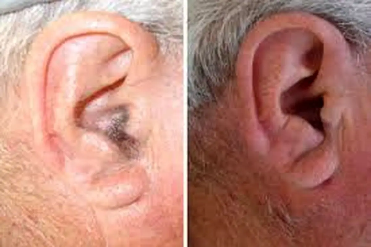 مو روی لاله گوش تا چه حد خطرناک است؟