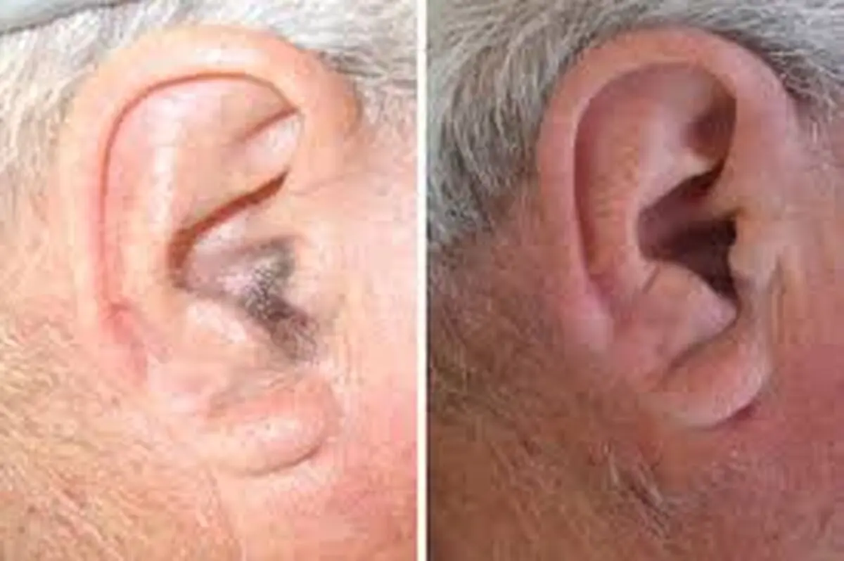 مو روی لاله گوش تا چه حد خطرناک است؟