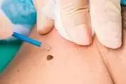 آیا می‌توان هر خالی را برداشت؟