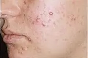 به خاطر پوستتان کمتر لوازم آرایش استفاده کنید