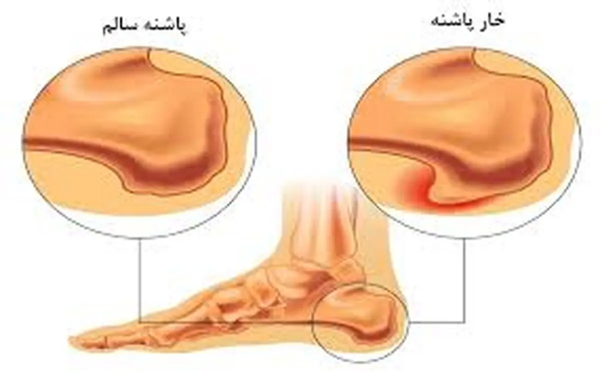 خارپاشنه عذابتان می‌دهد؟ بخوانید!