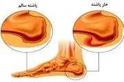 خارپاشنه عذابتان می‌دهد؟ بخوانید!