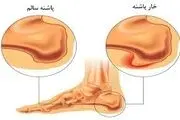 خارپاشنه عذابتان می‌دهد؟ بخوانید!