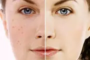 توصیه های موثر برای داشتن پوستی صاف و بدون لک