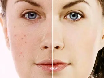توصیه های موثر برای داشتن پوستی صاف و بدون لک