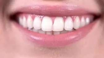 مزایا و معایب بلیچینگ دندان