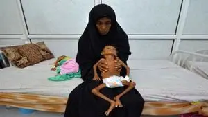 سوء تغذیه جان 85 هزار کودک یمنی را گرفت
