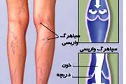 چگونه  از بروز رگ های واریسی جلوگیری کنیم؟