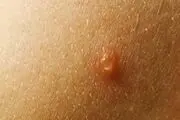 جوش های کمر نشانه چیست؟!!