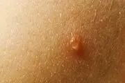 جوش های کمر نشانه چیست؟!!