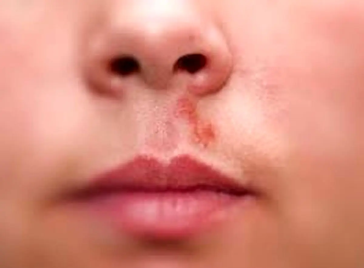 راهکار درمانی تبخال بینی