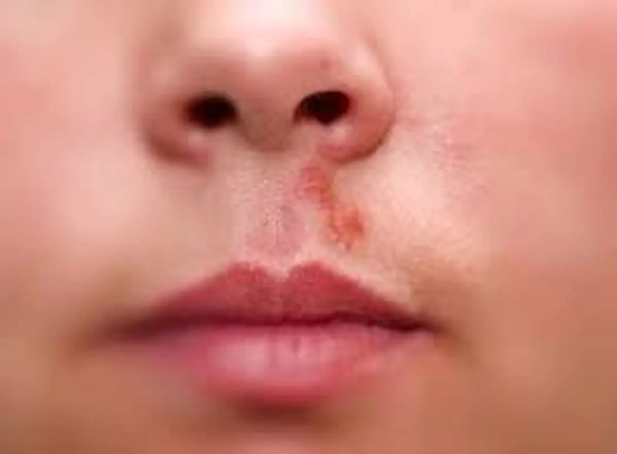 راهکار درمانی تبخال بینی