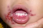 ساخت داروی آفت دهان، تبخال و تب برفکی