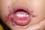 ساخت داروی آفت دهان، تبخال و تب برفکی