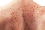 برای پیشگیری از سرطان پوست این موارد را رعایت کنید