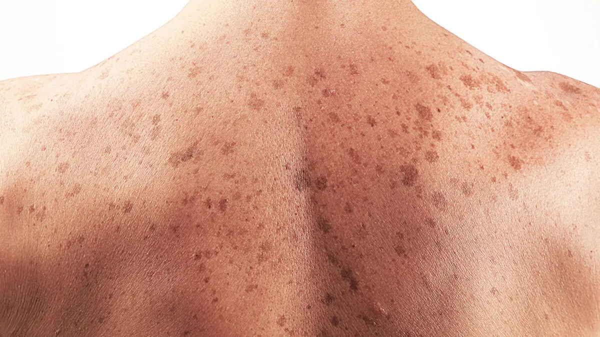 سرطان پوست؛ بیماری مرگبار مردان