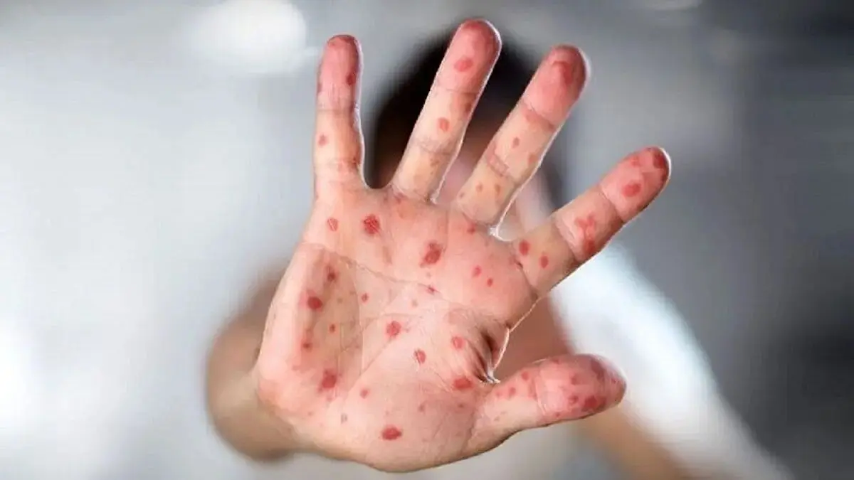 افزایش خطر ورود سرخک به ایران از مبادی مرزی عراق!
