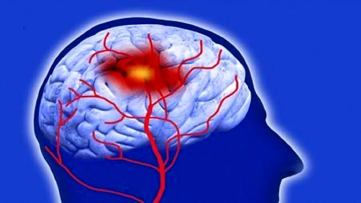 ابداع فناوری جدید برای رصد احتمال سکته مغزی
